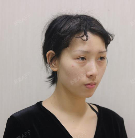 我的面颊凹陷比较厉害,朋友有时候都开玩笑说看着我,觉得有点"丧"的