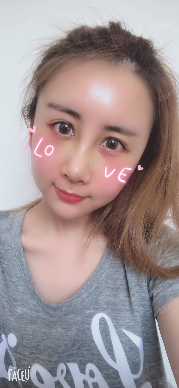 氧气0rsin自体脂肪全脸填充第10天美丽日记