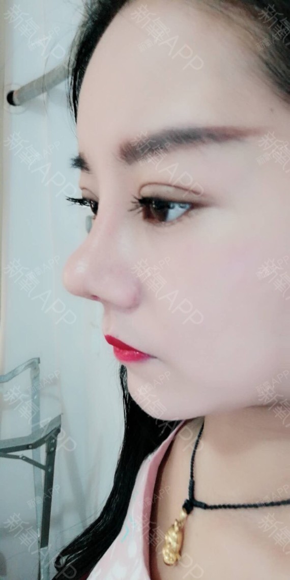 今天是做完隆鼻后的20天,外出游玩的照片,面部的立_圈子-新氧美容整形