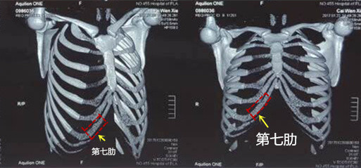 取肋软骨时一般是取哪根软骨 有什么区别 新氧美容整形