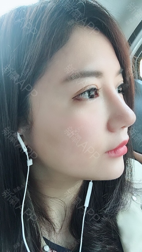 武汉手术缩鼻翼好不好_效果图_氧气0a2fv手术缩鼻翼术后第27天_新氧