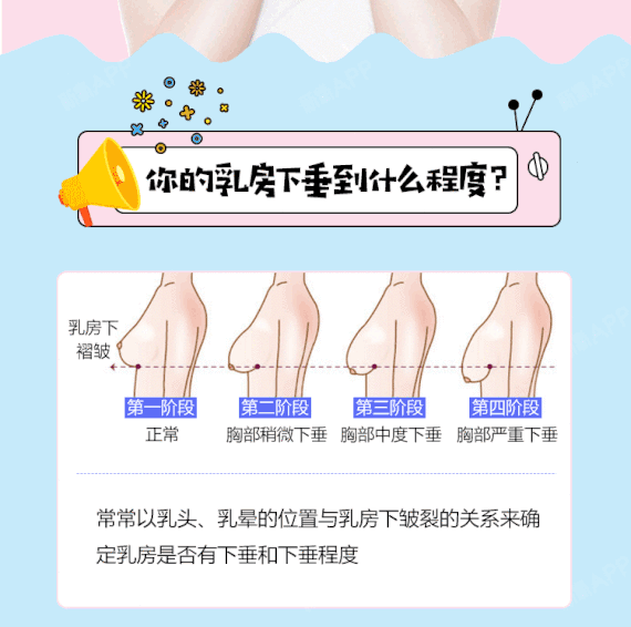 【乳房下垂矫正】【胸部提升】改善产后胸部下垂 无疤痕不影响哺乳