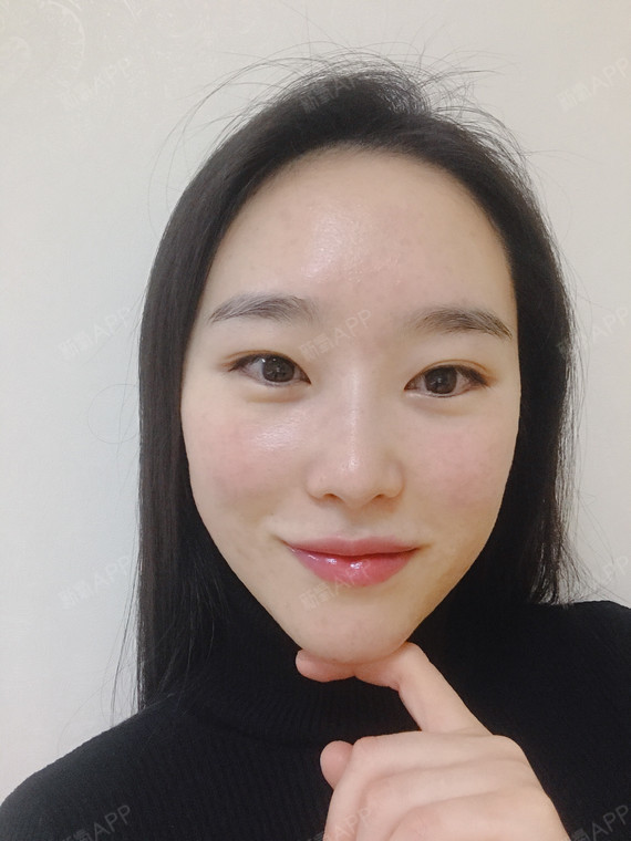 玻尿酸面部填充之丰苹果肌的第三天.