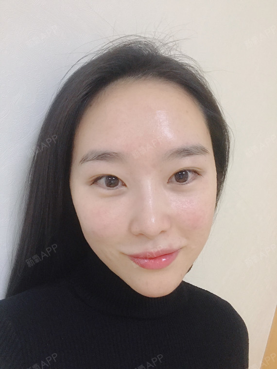 玻尿酸面部填充之丰苹果肌的第三天.