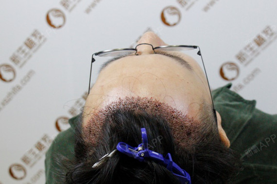 【深圳新生植发,术后4天】之前没有头发的区域被头发