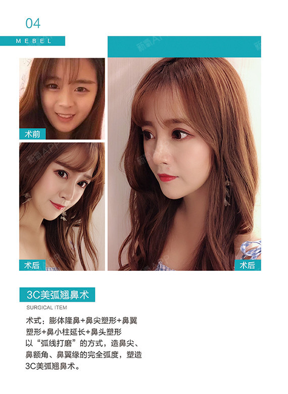 隆鼻失败其实是很小概率的三无美容院小诊所才