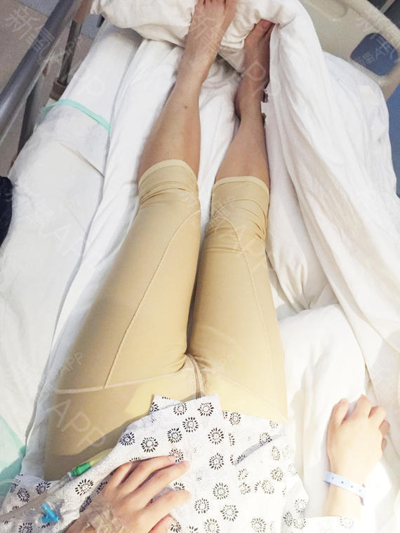 我做的是吸脂瘦大腿