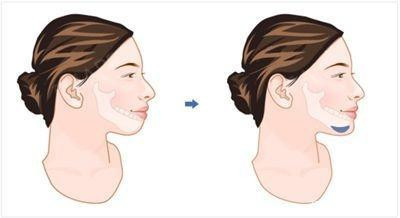 先来说说假体隆下巴.