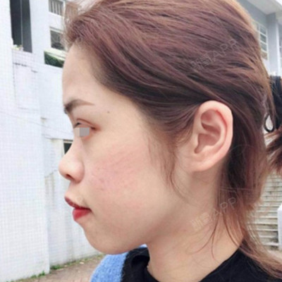 侧面看下巴一点都不明显,嘴_圈子-新氧美容整形