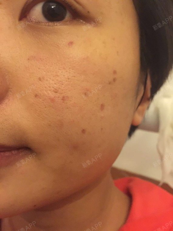 术后第三天,术后注意不沾水,开始结痂,等着掉痂都的效果哦