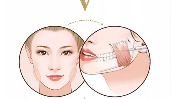 瘦脸针一针可以保持多久?多少钱?张细巧美观
