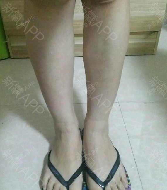 【武汉新至美-肉毒素瘦小腿-术后15天】今天是打完_圈子-新氧美容整形