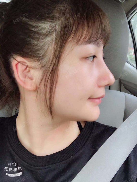 水的记忆鼻综合术后第90天美丽日记_新氧整形