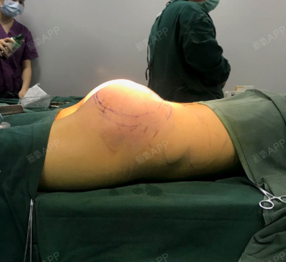 翘臀小公主假体丰臀第3天美丽日记