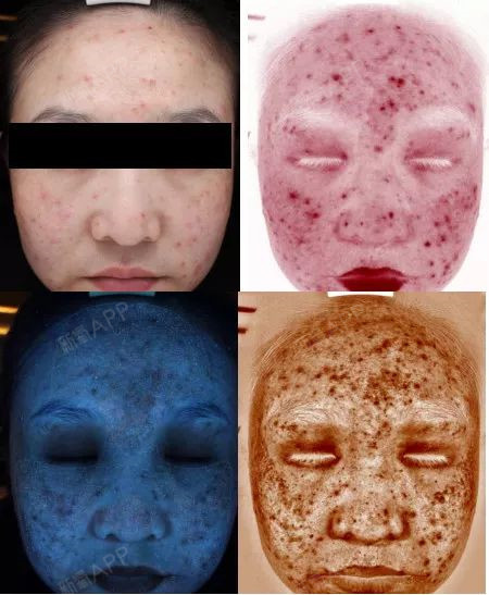 visia皮肤检测,皮肤问题一照便知!