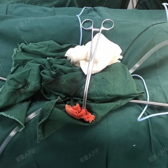 想到手术后有很多忌口,前一晚特意多吃了一些,医院附近有很多好吃的