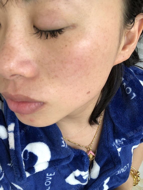 济南美辰皮秒祛斑今天是祛斑后第六天这两天结痂的部位_圈子-新氧美容