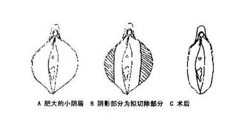 小阴唇肥大是因为性生活过多吗 新氧美容整形