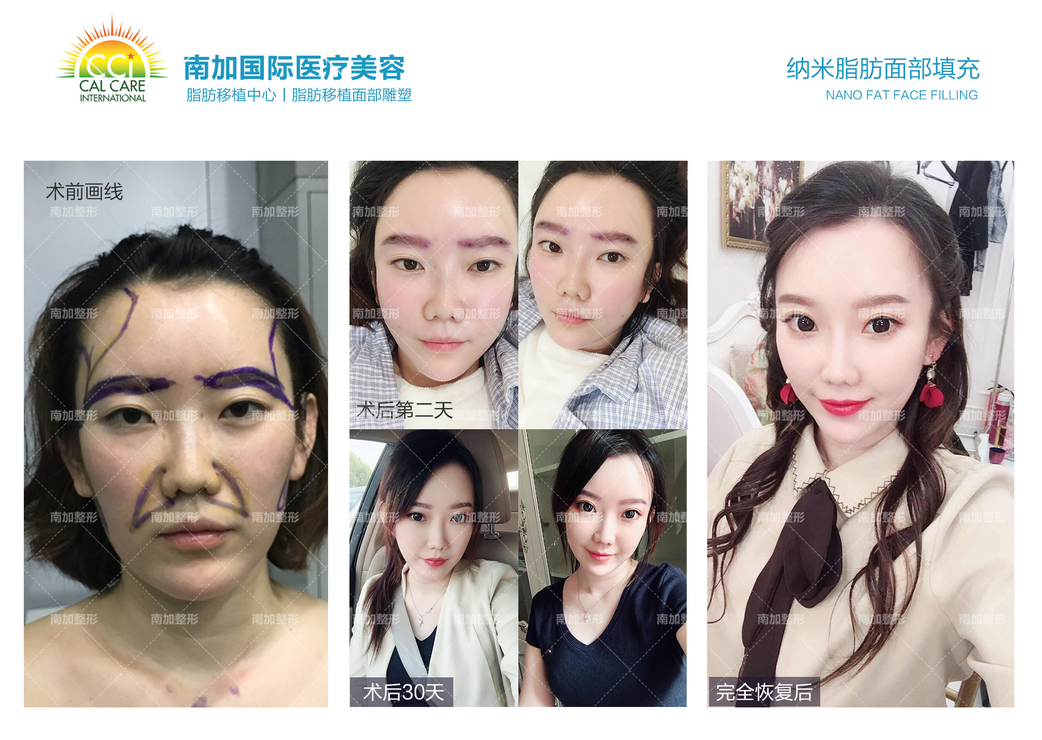 怎么办今天填充第12天了依旧肿的跟猴子 新氧美容整形