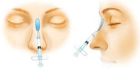 假体隆鼻又分为硅胶隆鼻和膨体隆鼻