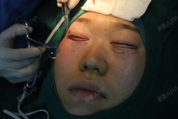 长沙外切去眼袋好不好_效果图_美美丽丽不外切去眼袋术后第1天_新氧