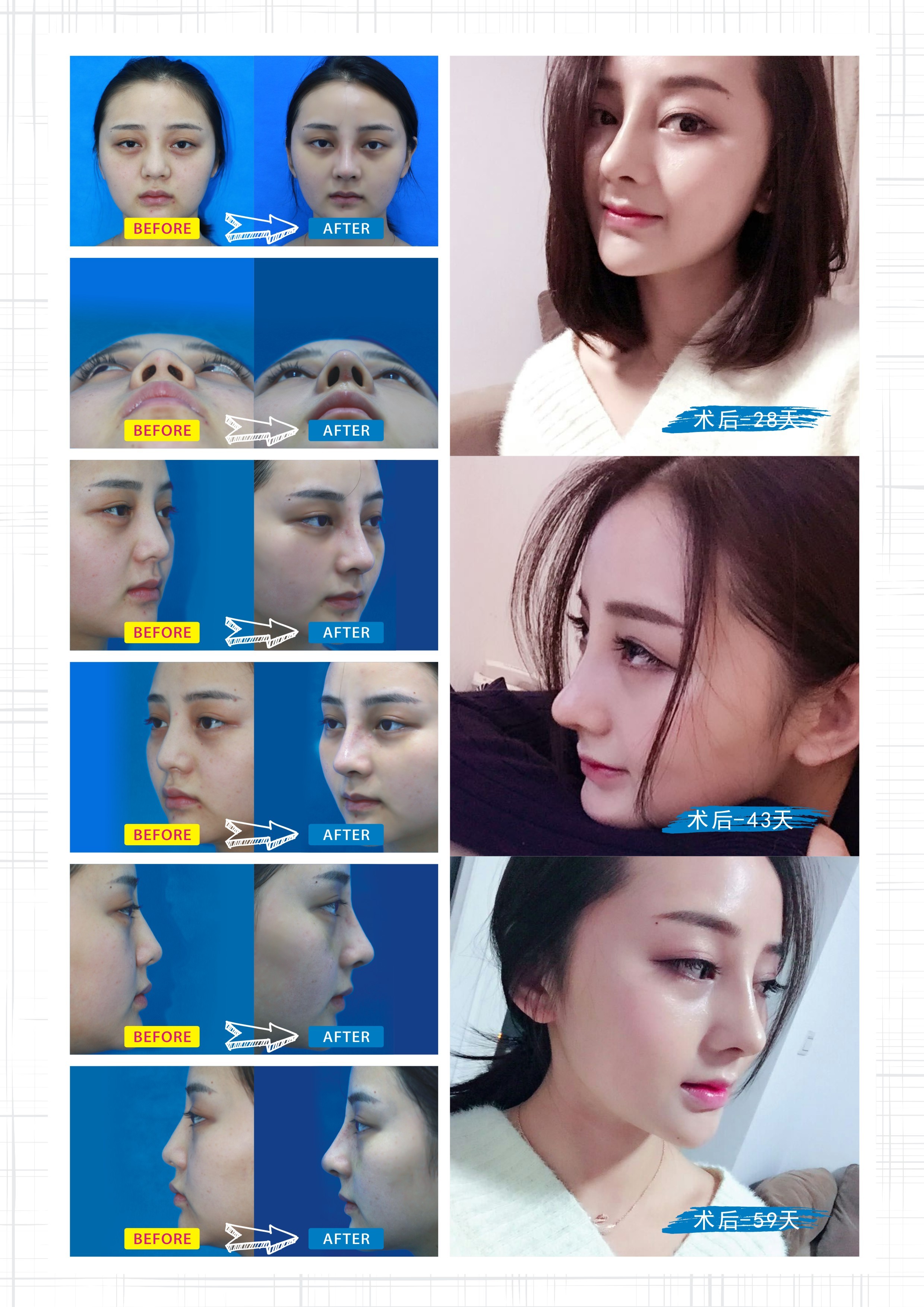 硅胶隆鼻会透光怎么办 硅胶鼻子变透明的真正原因?