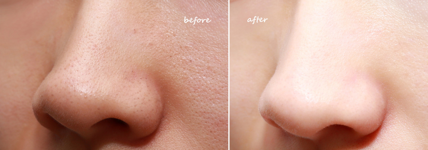 收缩毛孔是激光好还是微针好