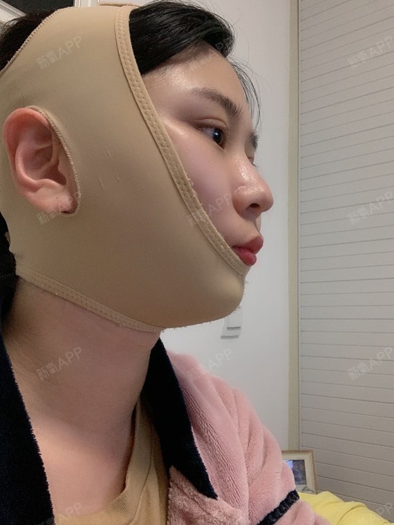 做完面吸第3天啦,每天都带着颈颌套,第一天的时候还_圈子-新氧美容