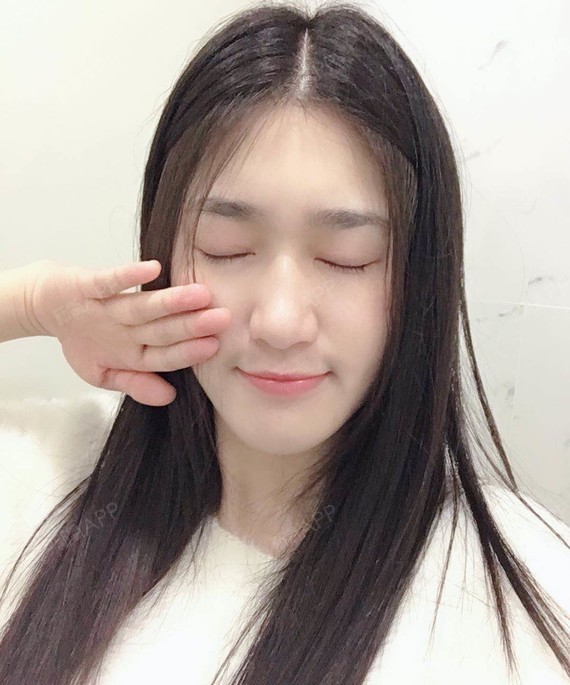 【苏州美莱双眼皮术后第150天】闭上眼睛还有点淡淡_圈子-新氧美容