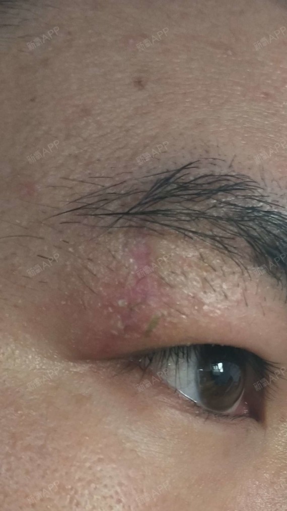 做完激光已经二十天了,今天结痂才全部掉完,颜色淡