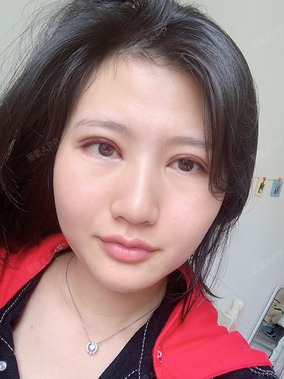 氧气zznif切开双眼皮第3天美丽日记