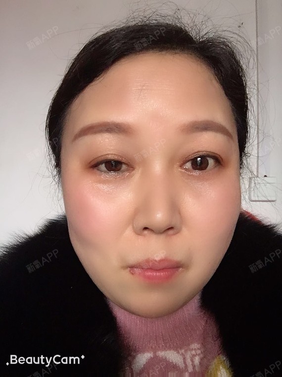 武汉美基元外切祛眼袋第22天