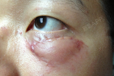 避免出现眼袋内吸副作用!