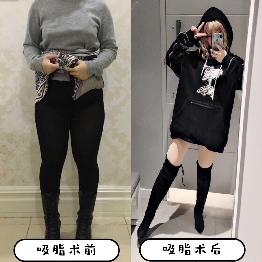 71抽了1700ml的脂肪腿会瘦成什么样70
