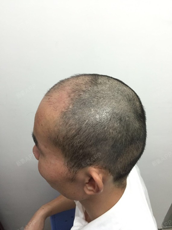 今天是做完植发术后术后的50天了,头发也是进入了脱_圈子-新氧美容
