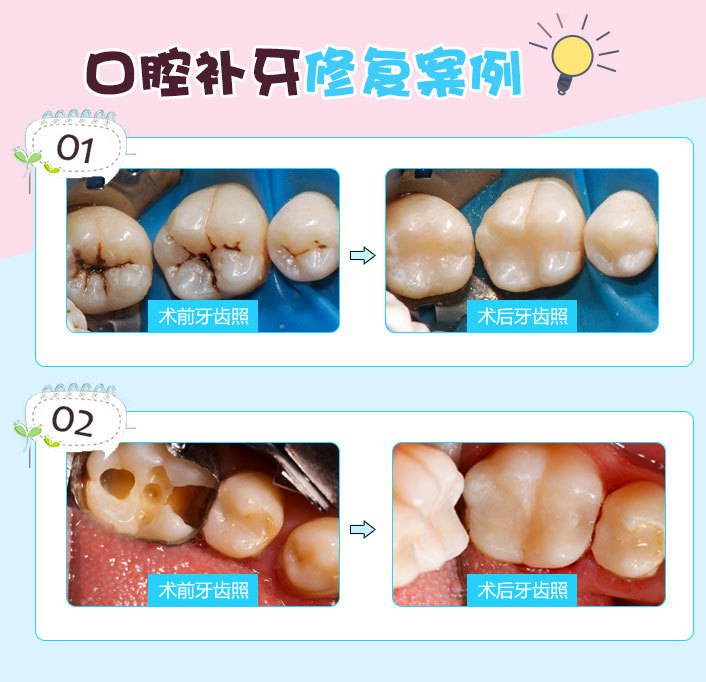 大牙有一個蟲洞,目前吃東西不疼,這樣可以直接補上嗎?