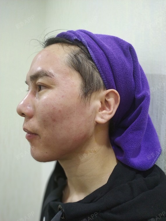 微针美塑好不好_效果图_阿迪0迪微针美塑术后第天_新氧美容整形