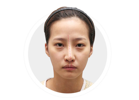 鼻子有轻微的歪斜应该怎么矫正困难吗