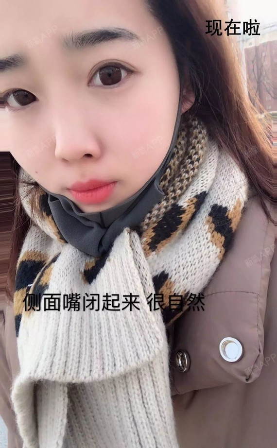 也没有疼痛感,不过拿下来之后有点酸,之后去吃汉堡,一口咬下去,感觉