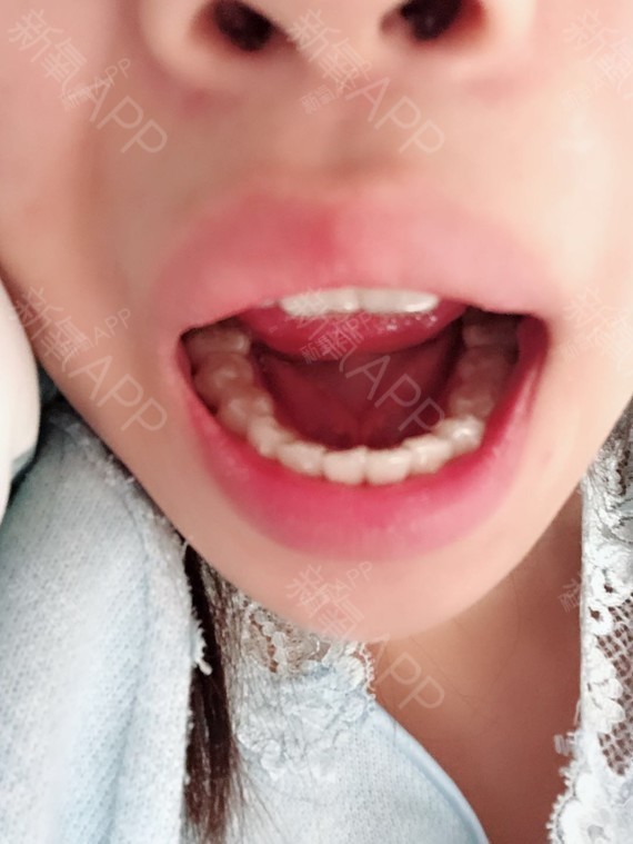 以前很好奇表妹一口的钢牙是什么感觉,这次去她家给她看了我带的隐形