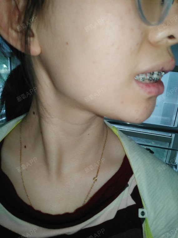 第三次记录这周做了个小手术――唇系带过低切除,过程_圈子-新氧美容