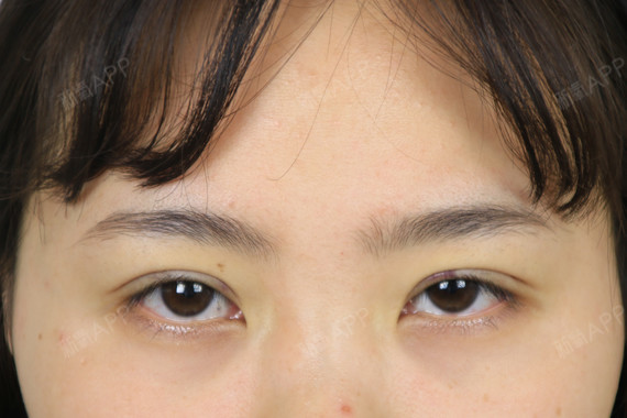 今天给大家带来一则"三角眼"的案例~妹子是天生的肿_圈子-新氧美容