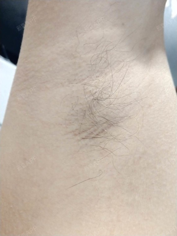 果然如王主任说的那样,腋下的毛毛如期长出,但是变细_圈子-新氧美容