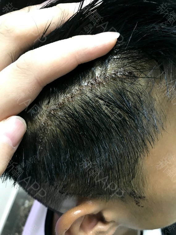 头皮手术疤痕图片