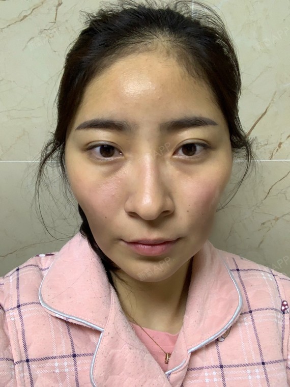 我的脸部从小就非常凹陷