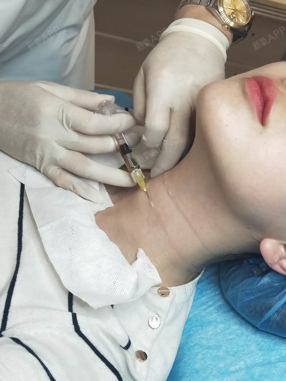 嗨体去颈纹好不好_效果图_氧气0zk4k嗨体去颈纹术后第6天_新氧美容