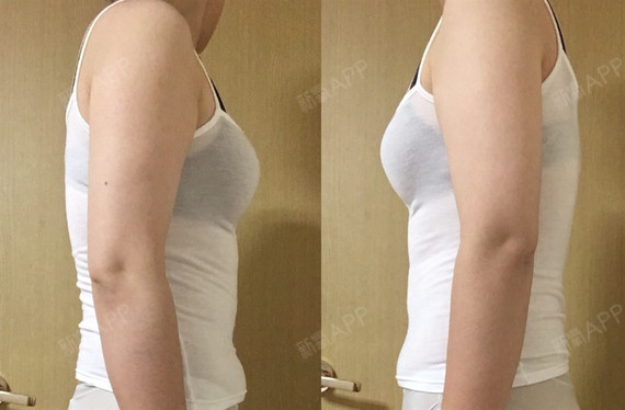  韩国自拍模特—手臂环吸真实案例>身高_圈子-新氧美容整形