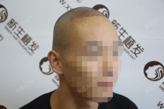 珠海做植发手术哪里好呢(珠海做植发手术哪里好呢知乎)