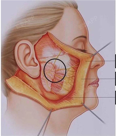 同时,将面部深部筋膜层smas也拉紧,切口多会选在发际内,耳旁或耳后等