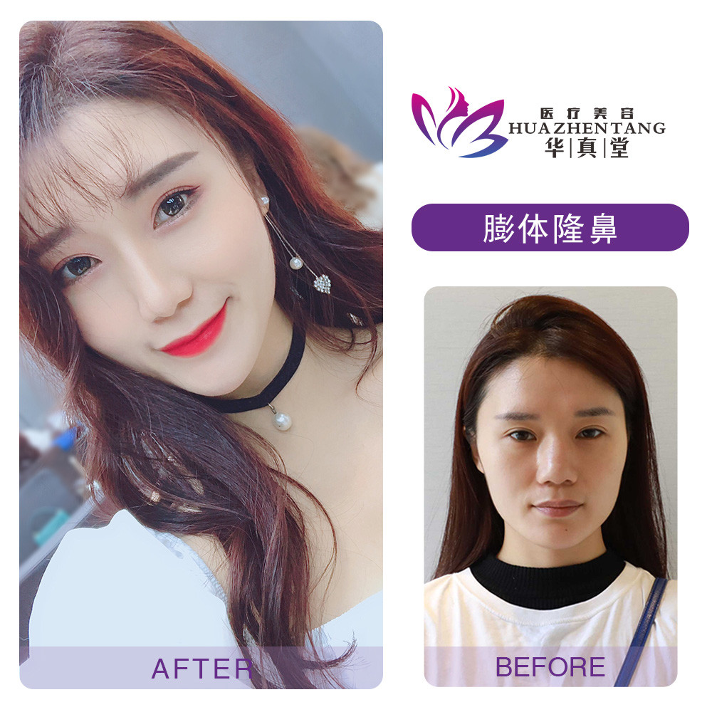 以下是本院假体隆鼻和玻尿酸隆鼻的真实案例,您可以看下参考下.